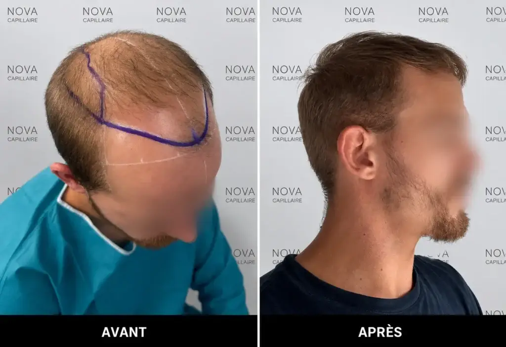 Comparaison avant-après montrant la repousse après une greffe de cheveux — cas 17