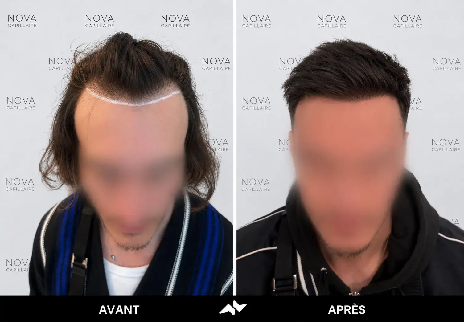 Comparaison avant-après montrant la repousse après une greffe de cheveux — cas 19