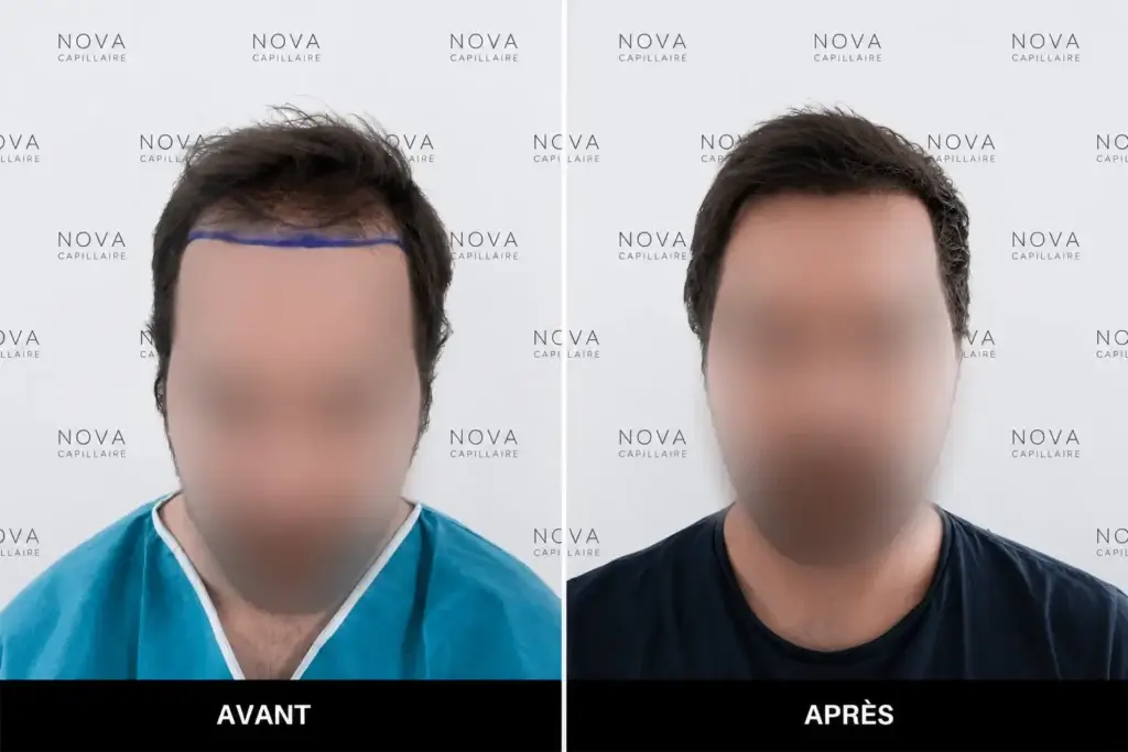 Comparaison avant-après montrant la repousse après une greffe de cheveux — cas 2