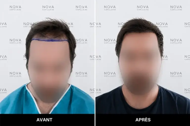 Comparaison avant-après montrant la repousse après une greffe de cheveux — cas 2