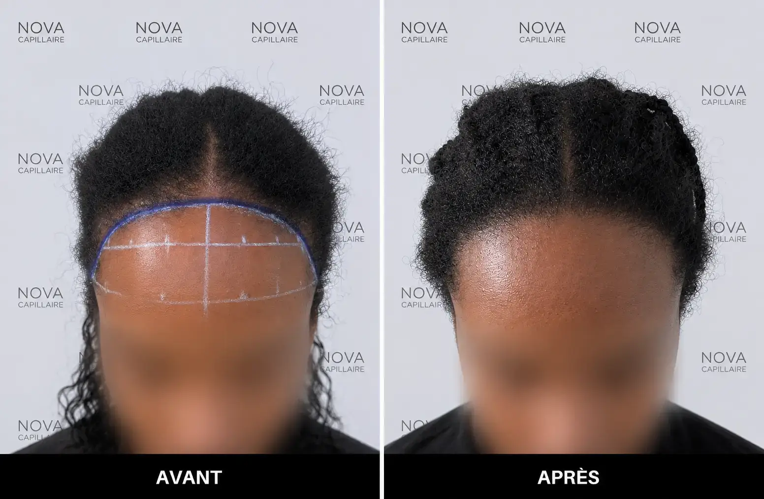 Comparaison avant-après montrant la repousse après une greffe de cheveux — cas 20