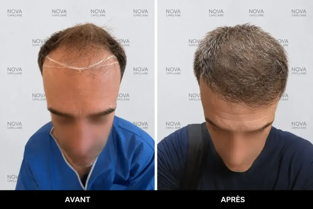 Comparaison avant-après montrant la repousse après une greffe de cheveux — cas 21
