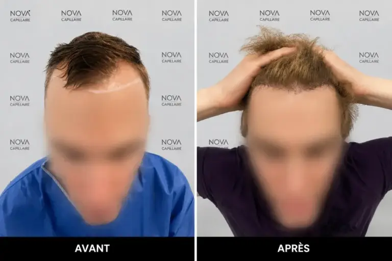 Comparaison avant-après montrant la repousse après une greffe de cheveux — cas 22