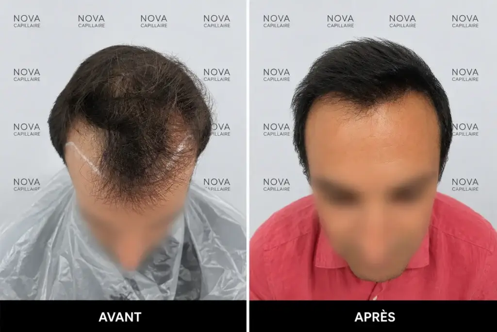 Comparaison avant-après montrant la repousse après une greffe de cheveux — cas 23