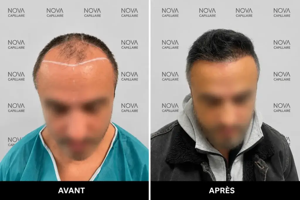 Comparaison avant-après montrant la repousse après une greffe de cheveux — cas 24