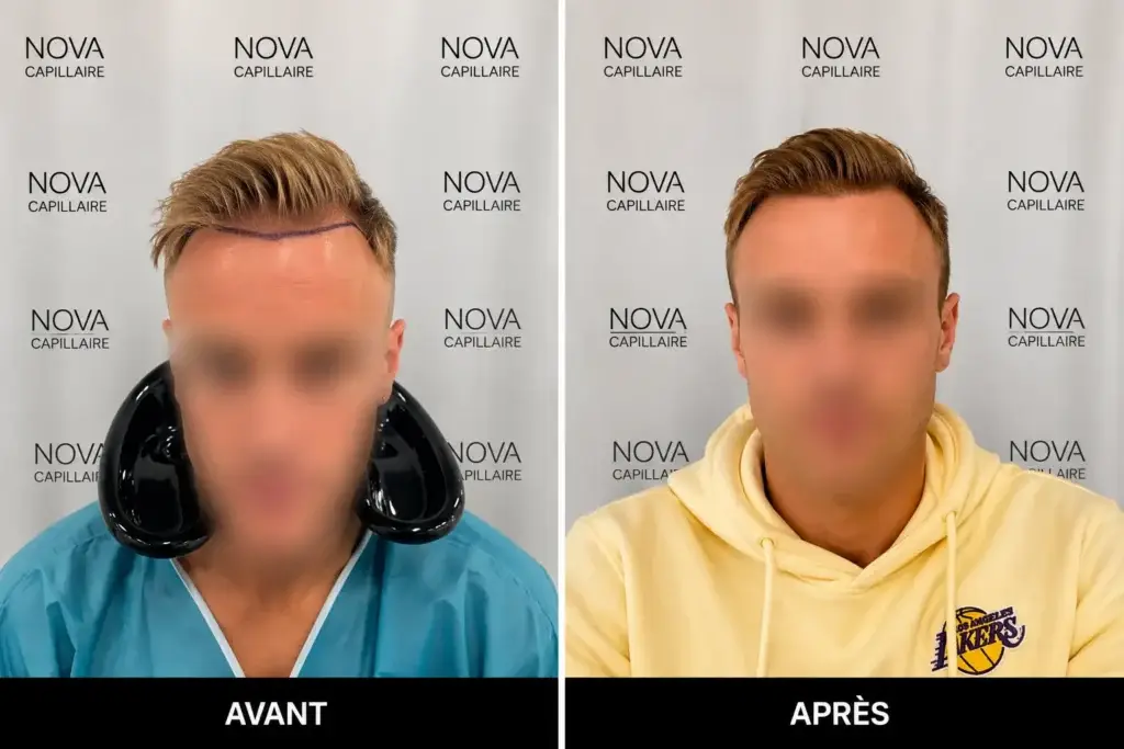 Comparaison avant-après montrant la repousse après une greffe de cheveux — cas 25