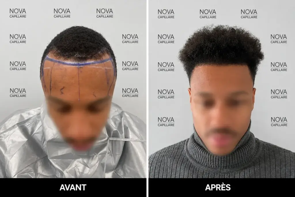 Comparaison avant-après montrant la repousse après une greffe de cheveux — cas 26
