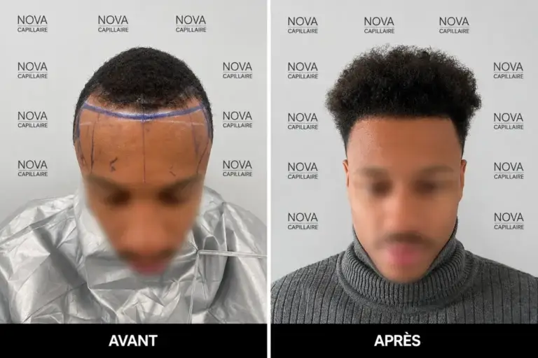 Comparaison avant-après montrant la repousse après une greffe de cheveux — cas 26
