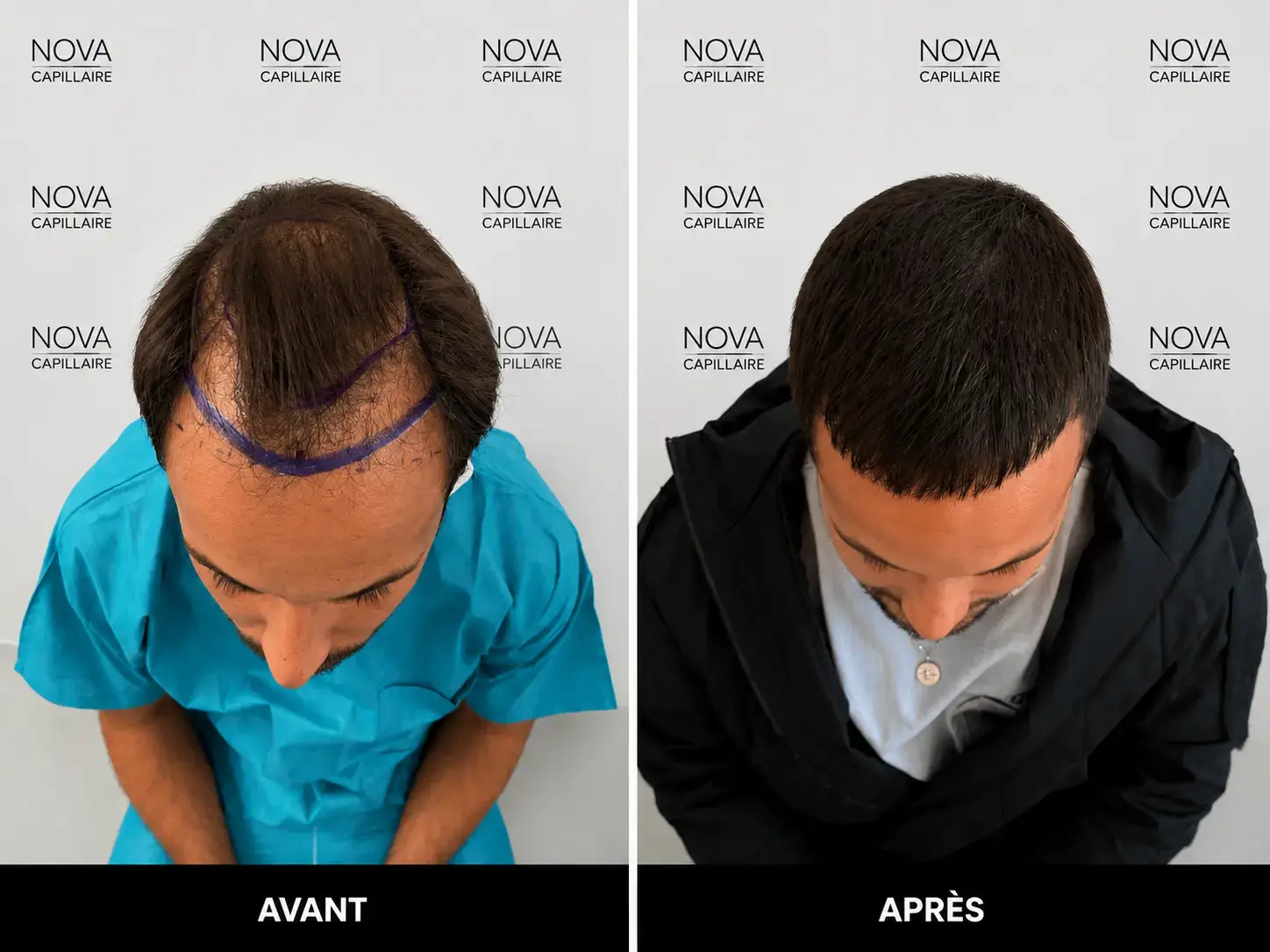 Comparaison avant-après montrant la repousse après une greffe de cheveux — cas 27
