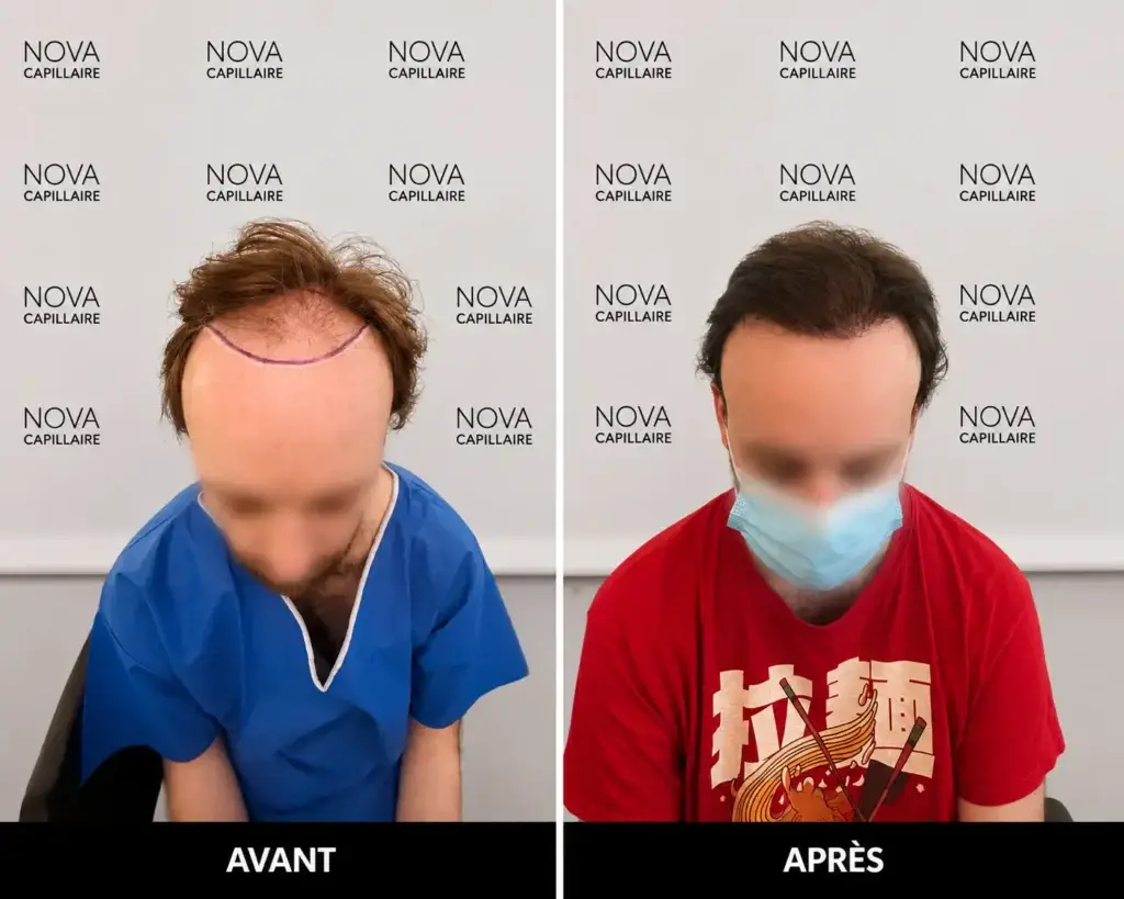 Comparaison avant-après montrant la repousse après une greffe de cheveux — cas 29