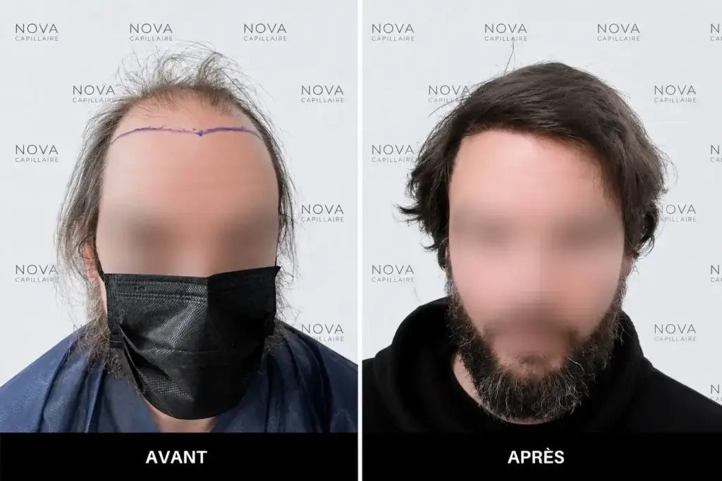 Comparaison avant-après montrant la repousse après une greffe de cheveux — cas 3