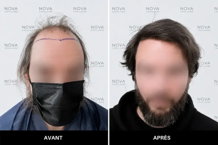 Comparaison avant-après montrant la repousse après une greffe de cheveux — cas 3