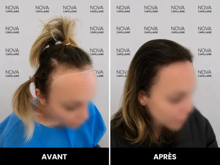 Comparaison avant-après montrant la repousse après une greffe de cheveux — cas 32