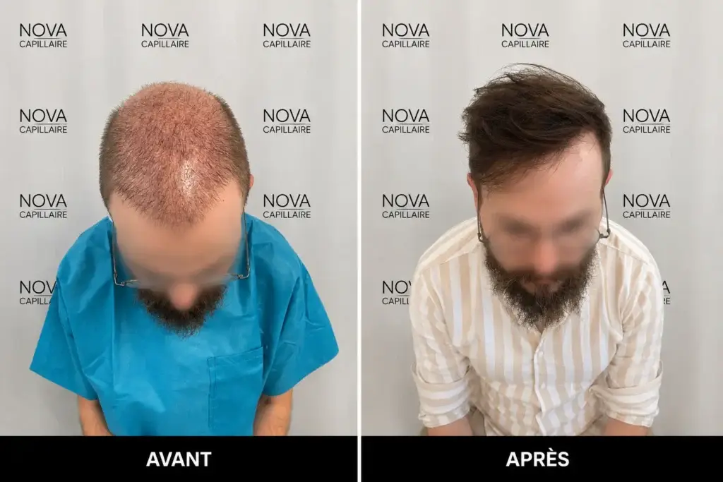 Comparaison avant-après montrant la repousse après une greffe de cheveux — cas 33