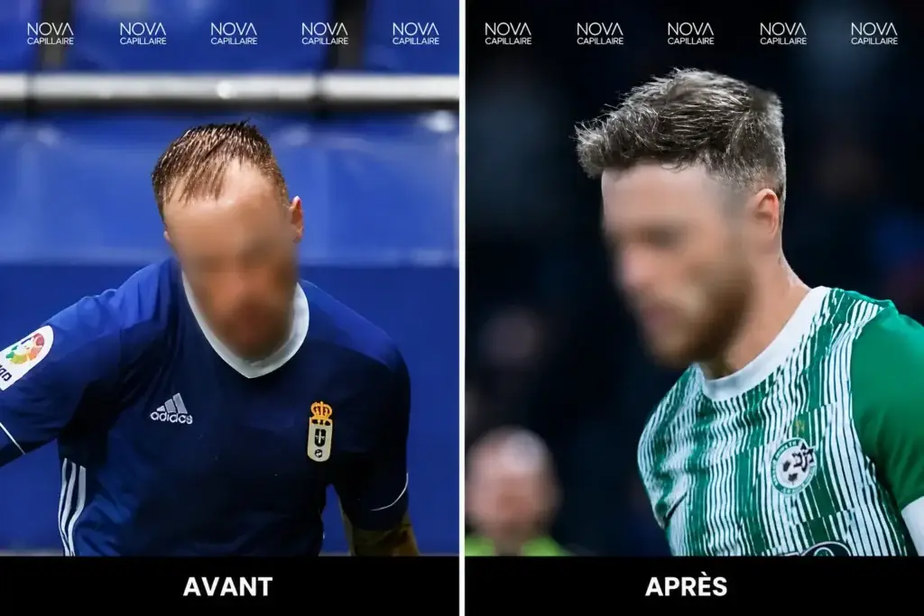 Comparaison avant-après montrant la repousse après une greffe de cheveux — cas 34