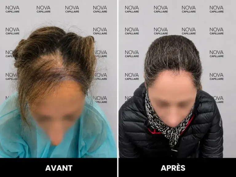 Comparaison avant-après de la densité capillaire d’une patiente après une greffe de cheveux