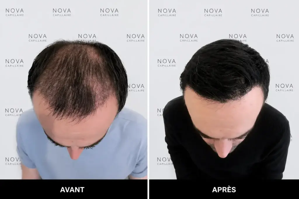 Comparaison avant-après montrant la repousse après une greffe de cheveux — cas 4
