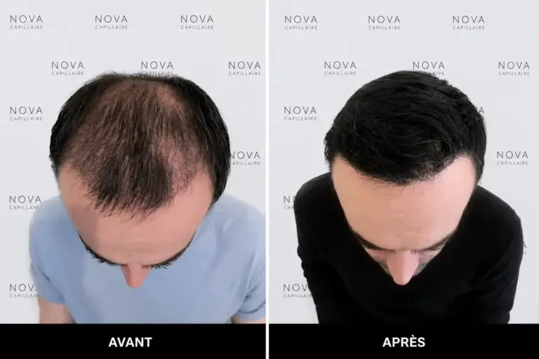 Comparaison avant-après montrant la repousse après une greffe de cheveux — cas 4