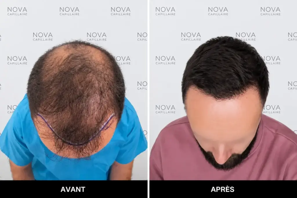 Comparaison avant-après montrant la repousse après une greffe de cheveux — cas 5
