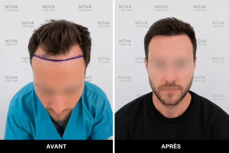 Comparaison avant-après montrant la repousse après une greffe de cheveux — cas 6