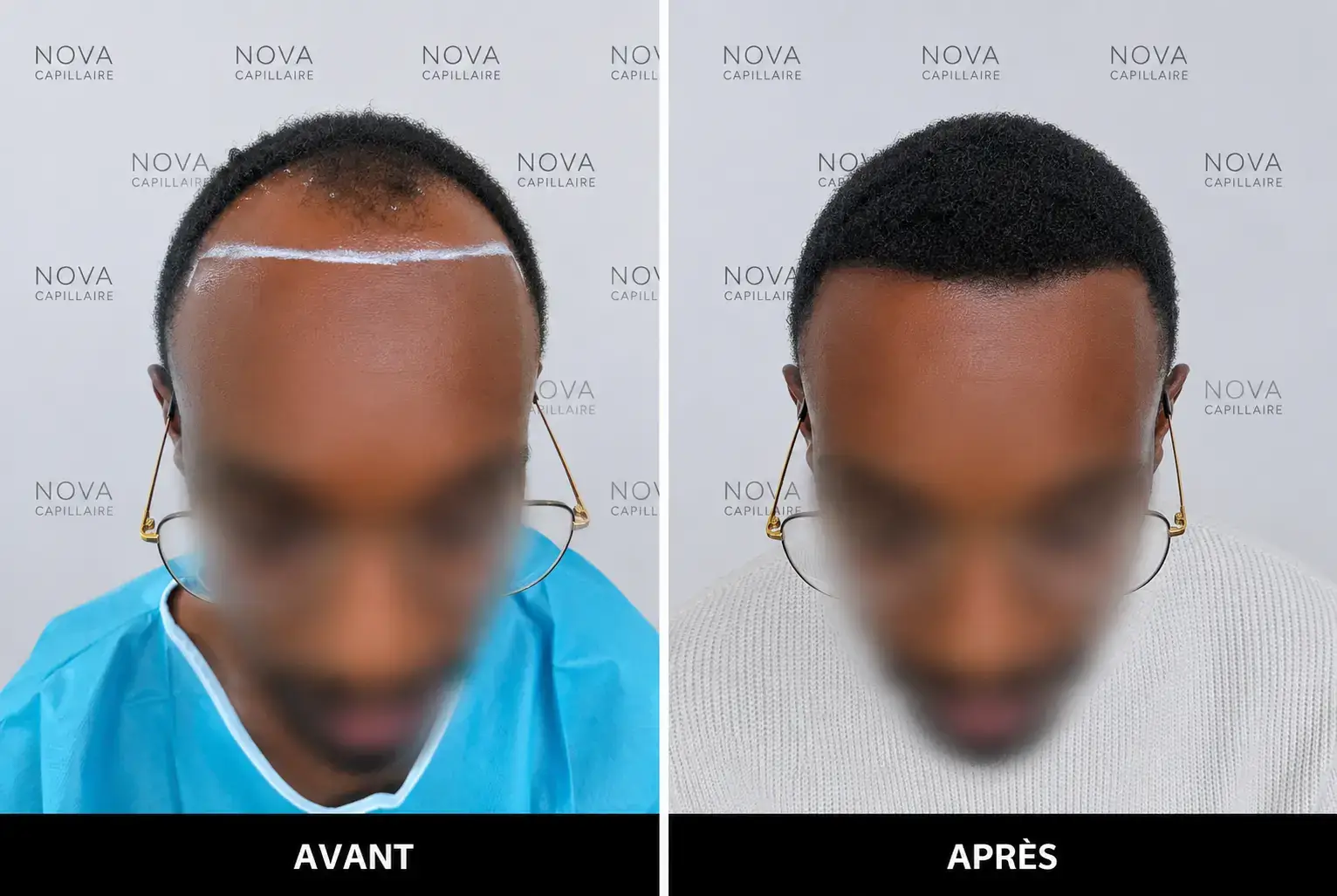 Comparaison avant-après montrant la repousse après une greffe de cheveux — cas 8