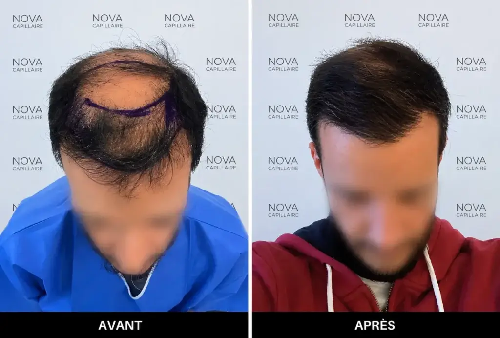 Comparaison avant-après montrant la repousse après une greffe de cheveux — cas 9