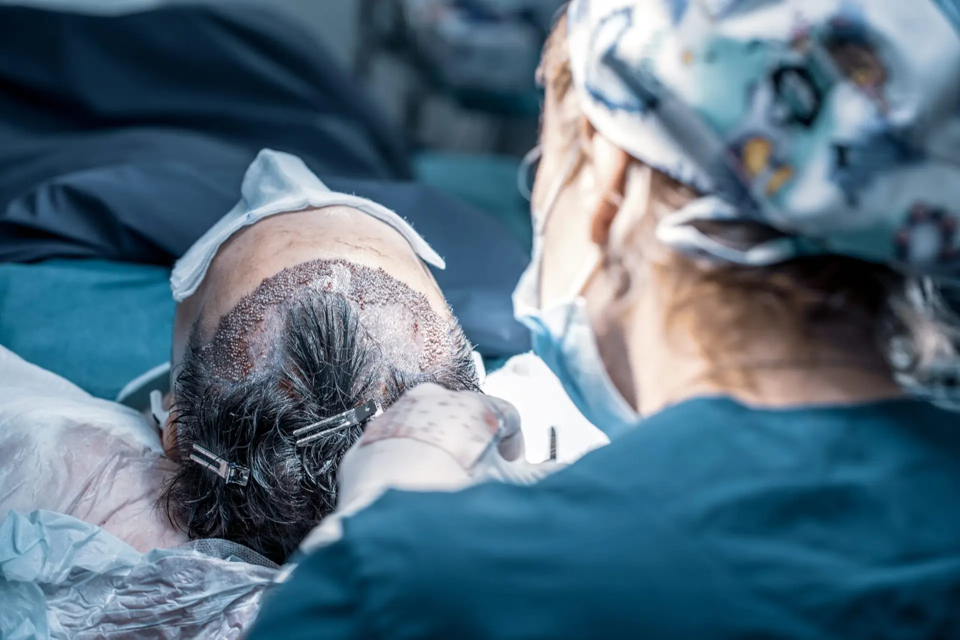 Transplantation de cheveux des régions frontales.