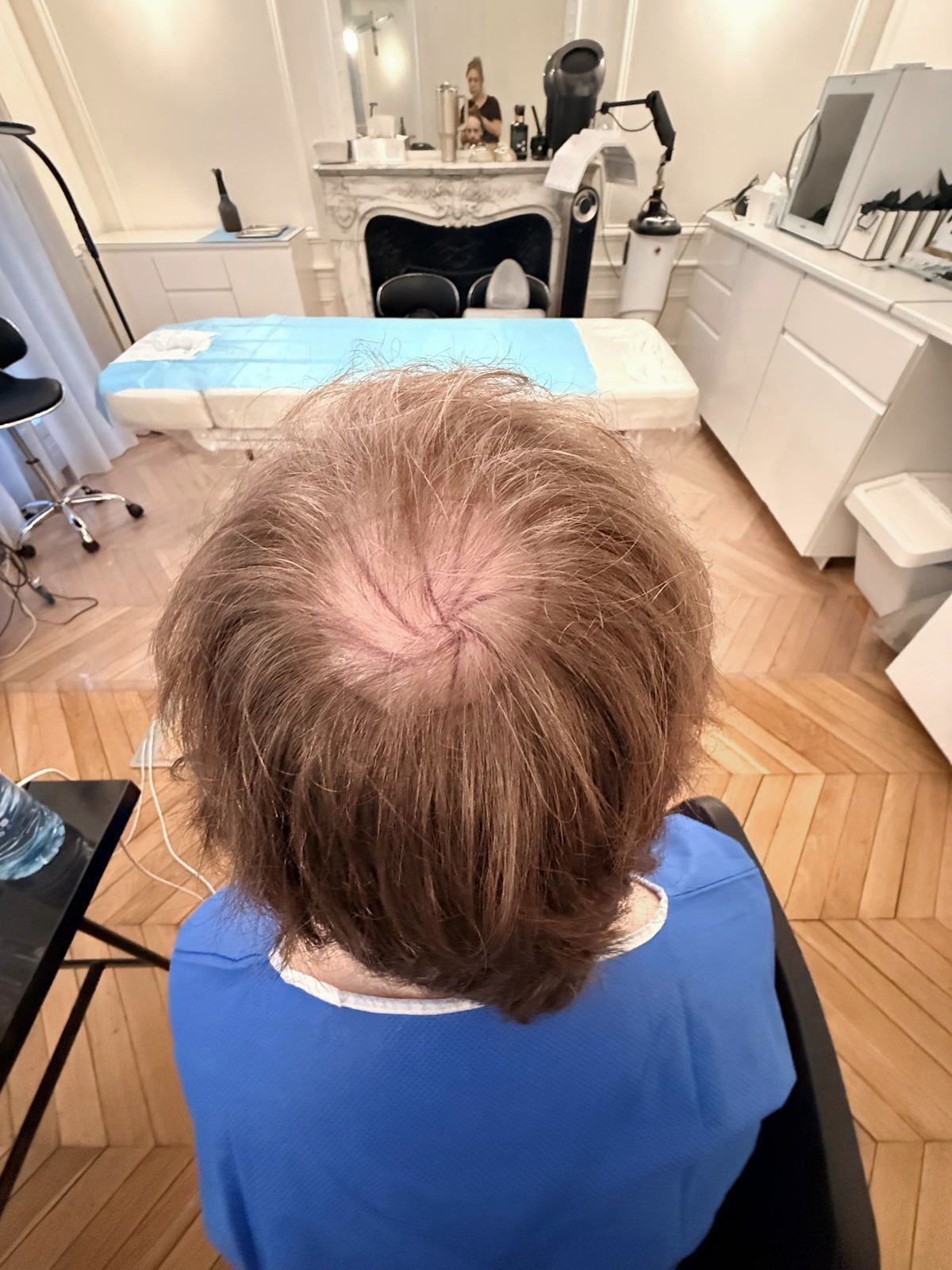 Vue du vertex avant la greffe avec le tracé de l’épi.