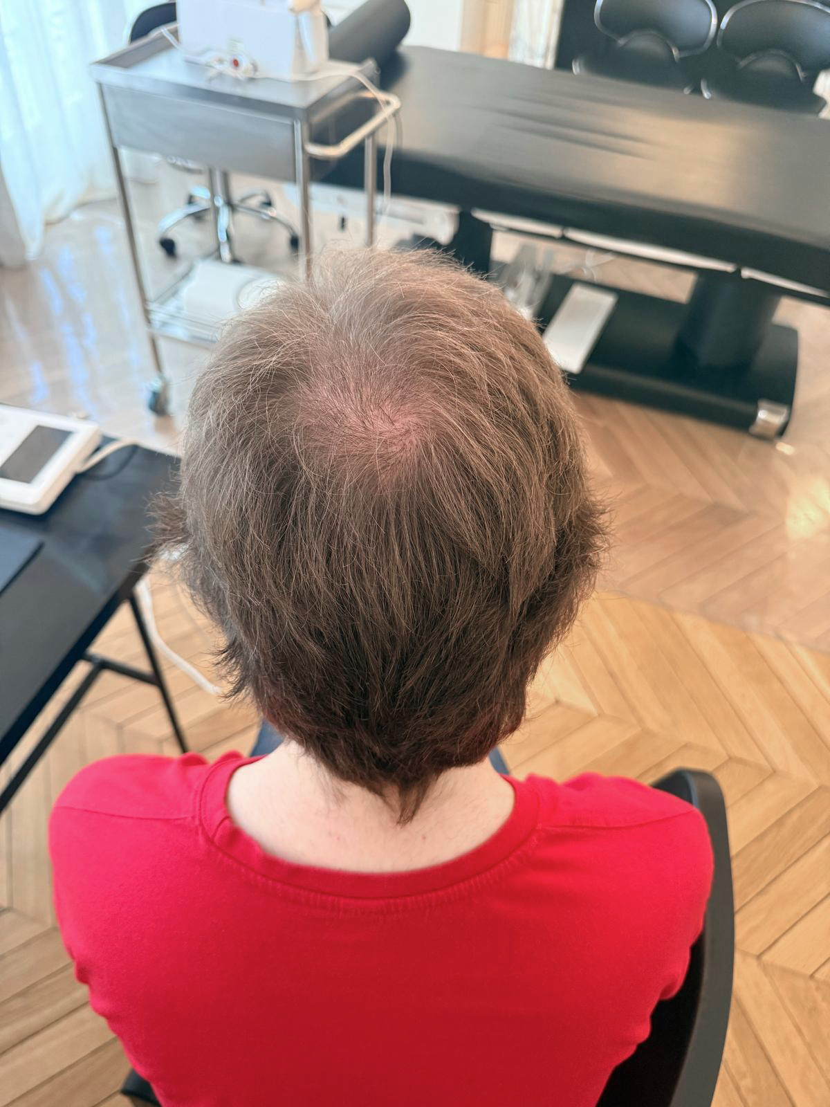 Vue du vertex après la greffe.