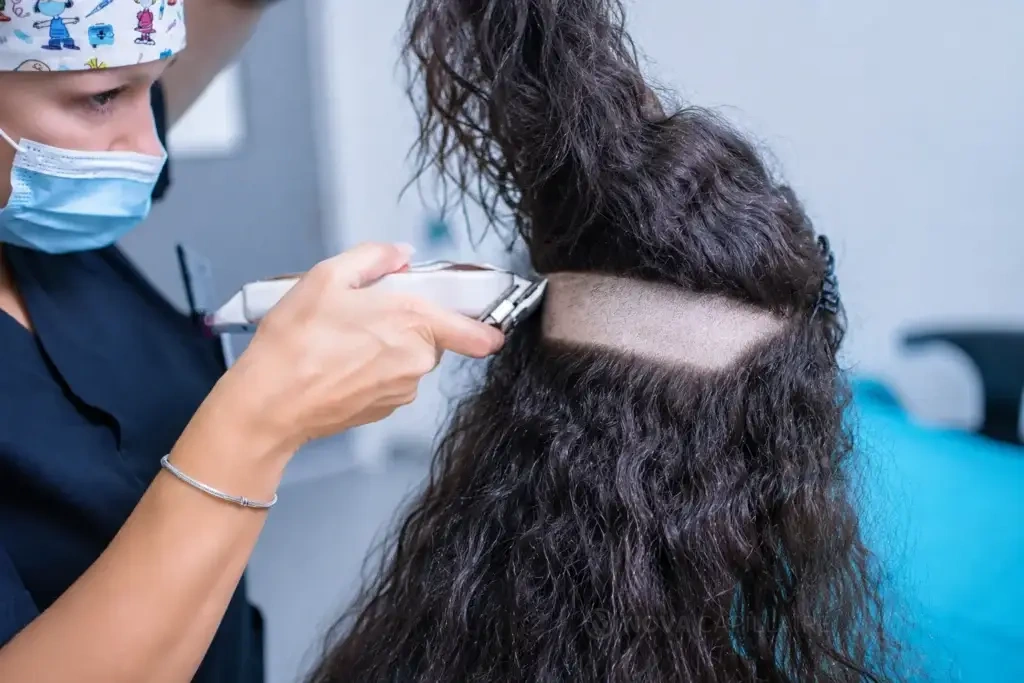 Partial shaving of a strip of hair in the donor area