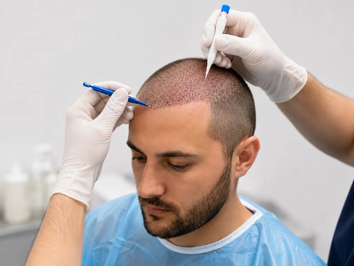 Comparaison entre FUE Saphir et CHOI Pen pour une greffe de cheveux