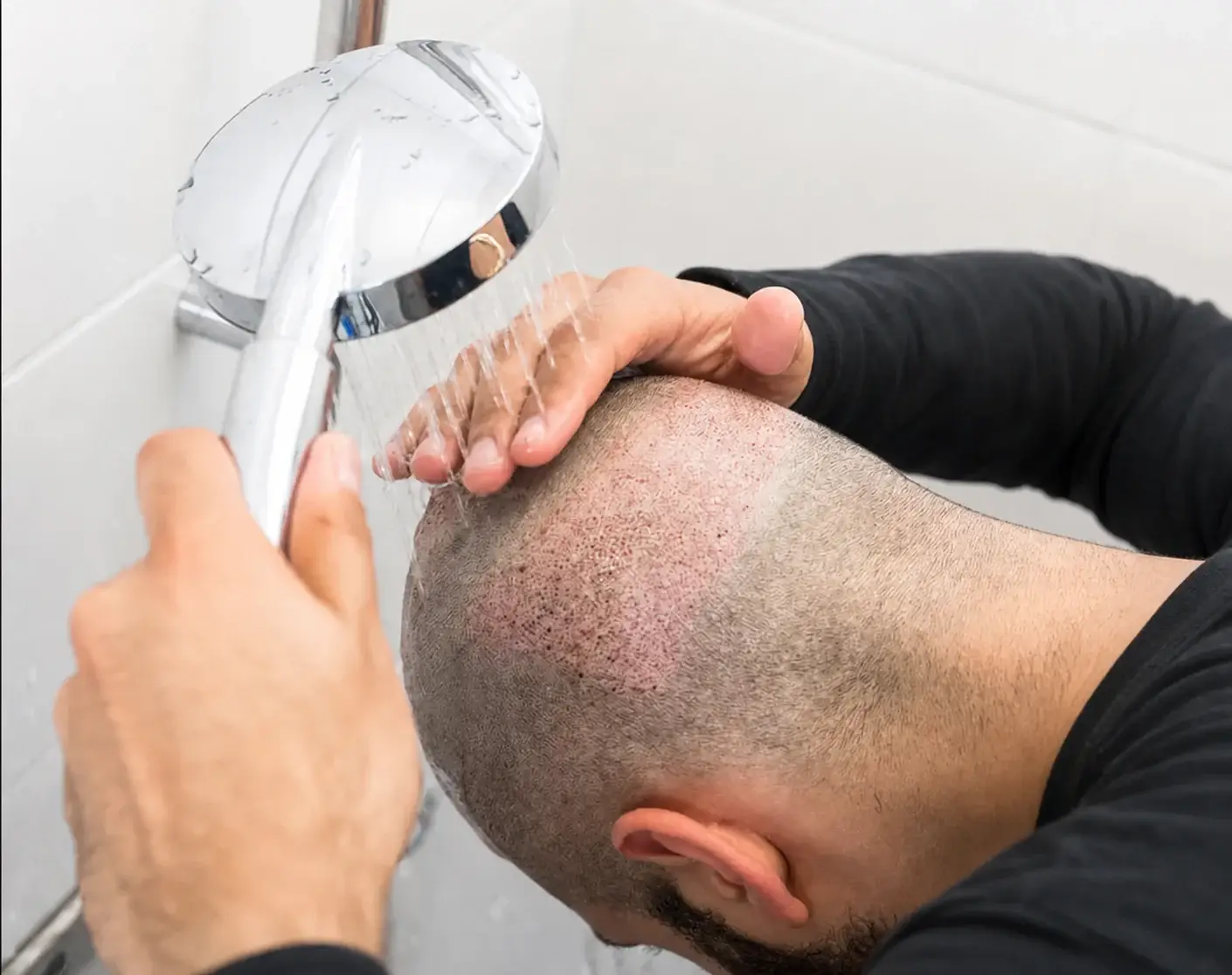 Soins après greffe de cheveux : rinçage très doux de la zone greffée à l’eau tiède