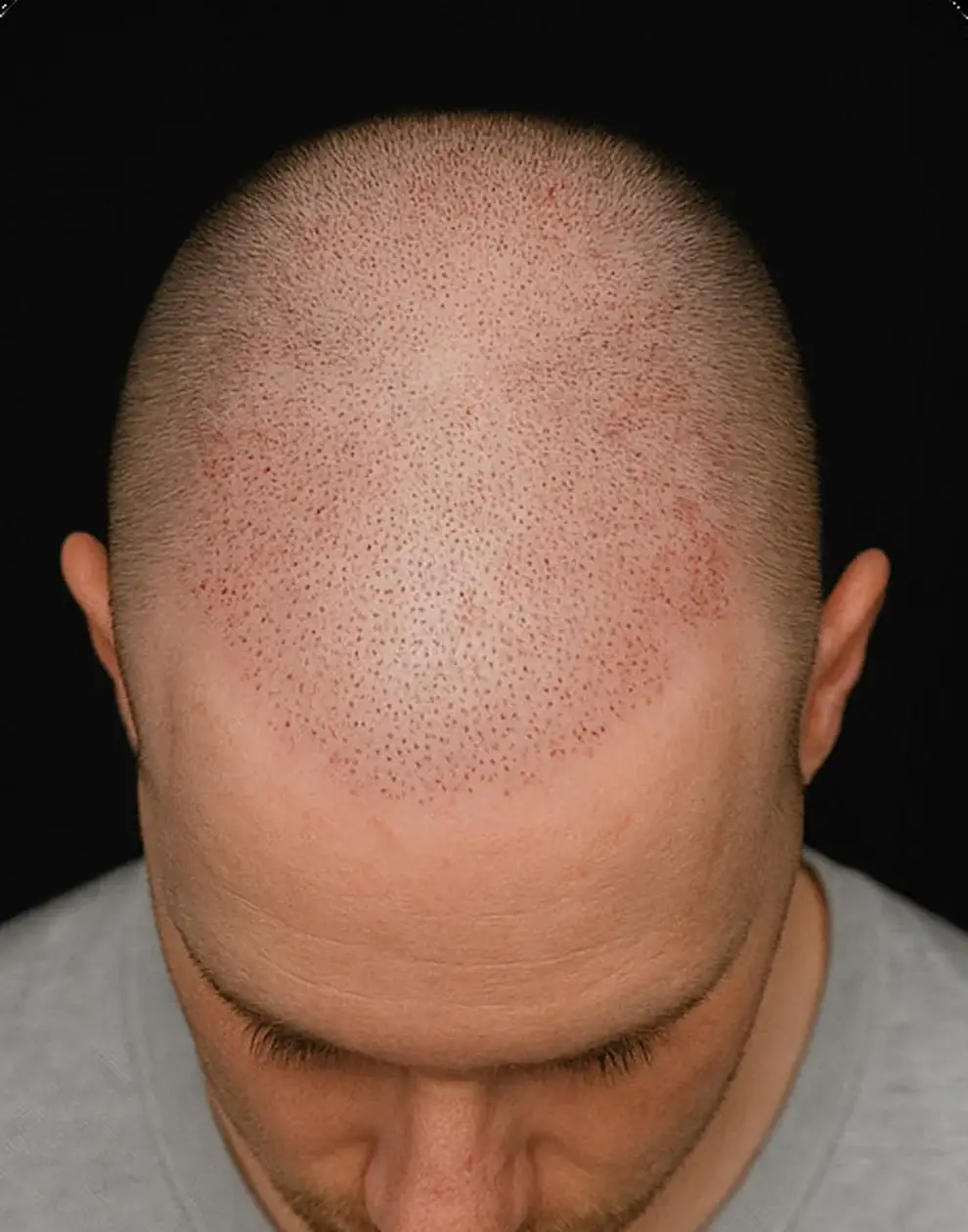 Photo de suivi vue du dessus montrant toute la zone greffée après une greffe de cheveux
