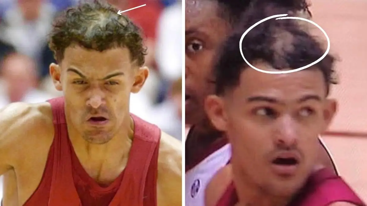 Trae Young et sa greffe de cheveux