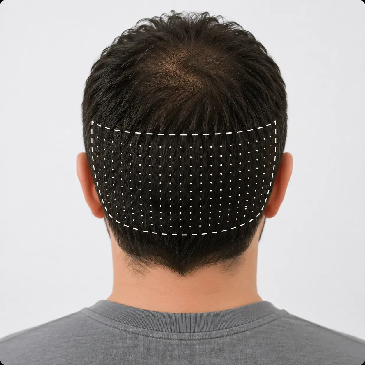 Repérage de la zone donneuse à l’arrière du cuir chevelu avant une greffe de cheveux